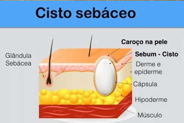Cisto sebáceo em cães - Tratamento e causas 1vettop% Cisto sebáceo2